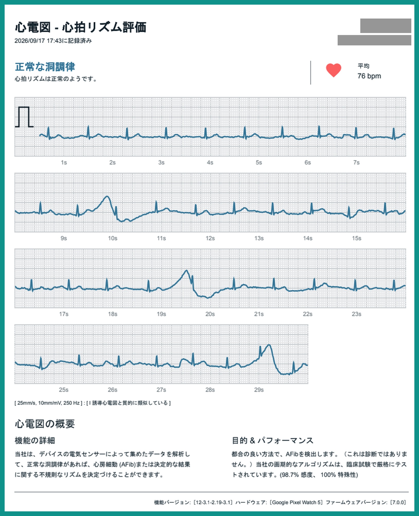 Pixel Watch 5 の心電図レポート。判定は正常な洞調律、平均76bpm。30秒ぶんの波形が4段に分かれて並び、下部に機能の説明とハードウェア名が記載されている